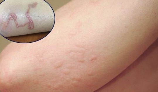 Người đàn ông 40 tuổi nhiễm giun sán chi chít trên người chia sẻ về thói quen ăn uống, trong đó có món nhiều người Việt thích mê