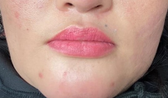 Tiêm filler làm đẹp chơi Tết, người phụ nữ 36 tuổi bị chảy dịch mủ trong miệng