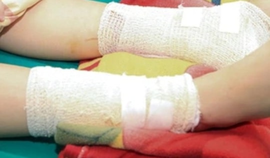 Bé gái bị bỏng nặng do nghịch cồn