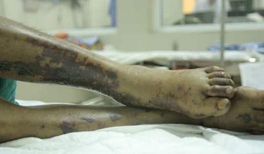 Nam bảo vệ nguy kịch do nhiễm vi khuẩn trong "món khoái khẩu"