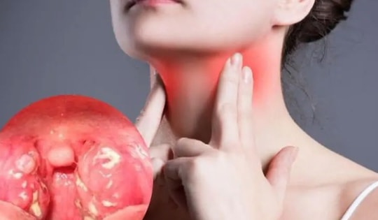 Bất ngờ 8 món ngon không nên ăn khi bị ho, viêm họng