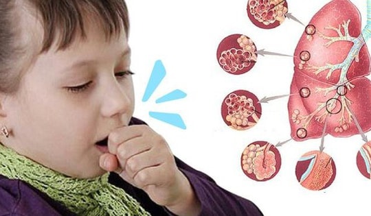 Dấu hiệu cảnh báo bệnh ho gà, căn bệnh này đáng sợ thế nào?