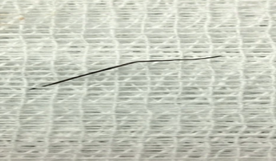 Gắp chiếc ghim sắt hồ sơ đâm thủng thành ruột non của nữ bệnh nhân