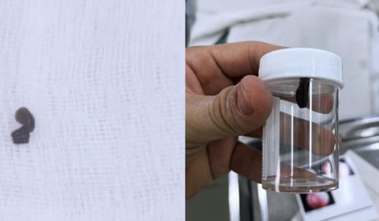 Bé 13 tháng tuổi phải mổ cấp cứu trong đêm khi phát hiện 'sinh vật lạ' lấp ló trong mũi