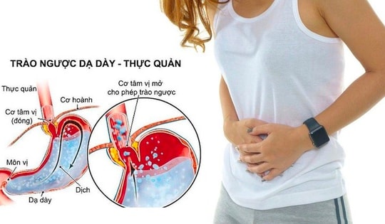 Dấu hiệu ho do bị trào ngược dạ dày, rất nhiều người không biết