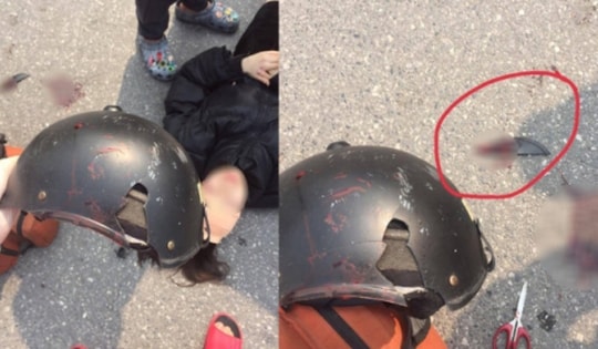 Cô gái ở Hà Nội bị mảnh vỡ của mũ bảo hiểm cắt vào đầu sau va chạm với xe ba gác