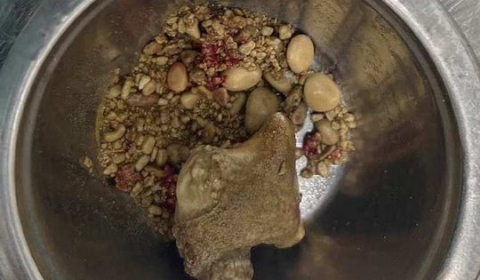 Phát hiện sỏi chi chít trong thận thanh niên 26 tuổi vì một sai lầm mà nhiều người Việt mắc phải