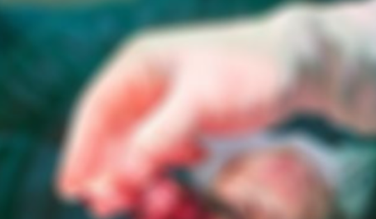 Bé gái lớp 7 dập nát bàn tay do điện thoại phát nổ