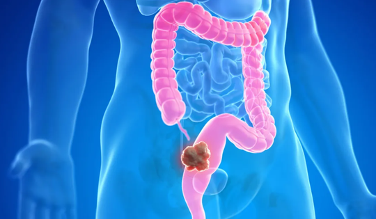 Ung thư đại tràng có phòng ngừa được không?