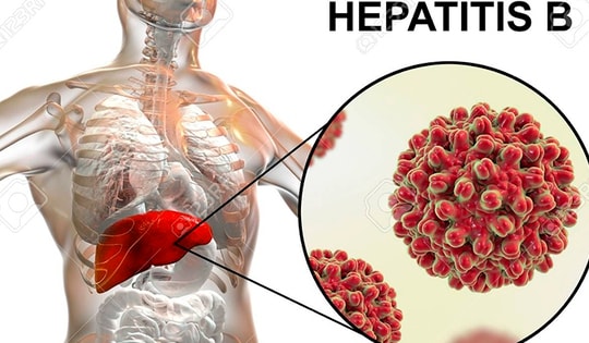 Đau bụng, người đàn ông 38 tuổi đi khám phát hiện có khối u gan 'khủng', đây có thể là nguyên nhân