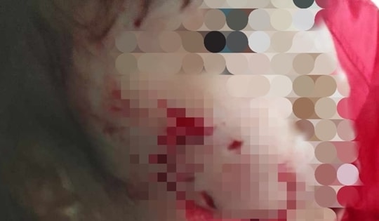 Bé gái 5 tuổi bị chó dữ cắn trọng thương vùng mặt