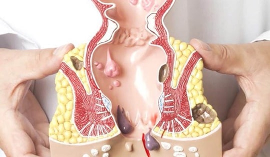 Vì sao bệnh trĩ tái phát, cần làm gì để phòng bệnh?