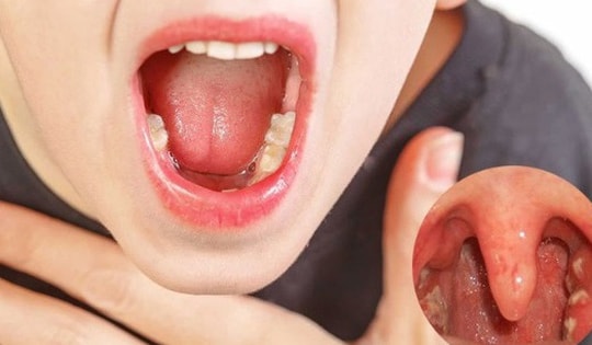 Viêm họng kéo dài, tái phát mãi không khỏi, đây có thể là nguyên nhân chính