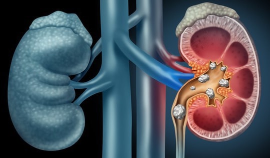 Những thói quen gây sỏi thận ít người biết