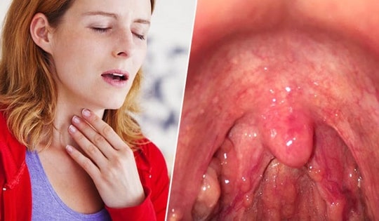 Bất ngờ 5 biến chứng đáng sợ của viêm họng mãn tính rất nhiều người không biết