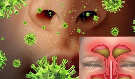 Trời mưa nồm ẩm, cảnh giác với viêm mũi xoang do nấm