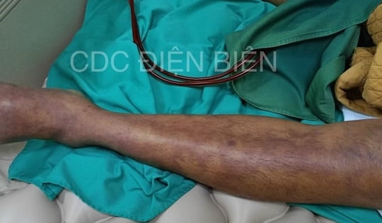 Người đàn ông 43 tuổi tử vong sau khi ăn món khoái khẩu từ thịt lợn