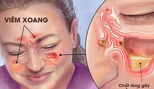 Thời tiết thay đổi, người bị viêm xoang cần làm gì để ngừa tái phát