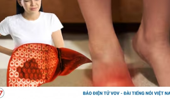 6 bộ phận trên cơ thể sưng tấy bất thường cảnh báo tổn thương gan nghiêm trọng
