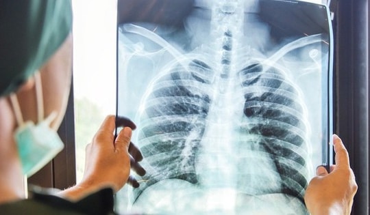 Việt Nam xếp thứ 11 trong 30 nước có gánh nặng bệnh lao cao, Thủ tướng ký công điện tăng cường phòng chống bệnh