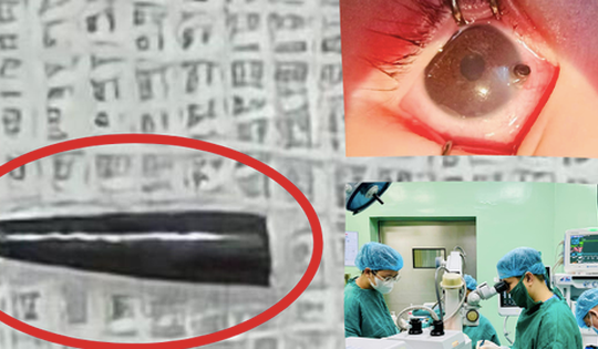 Phẫu thuật cấp cứu bé trai 9 tháng tuổi bị ruột bút chì xuyên thủng nhãn cầu
