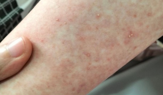 Bé 13 tuổi ở Quảng Ninh nổi mụn chi chít vì tự uống thuốc long đờm, đây là biến chứng đáng sợ nhiều người không biết