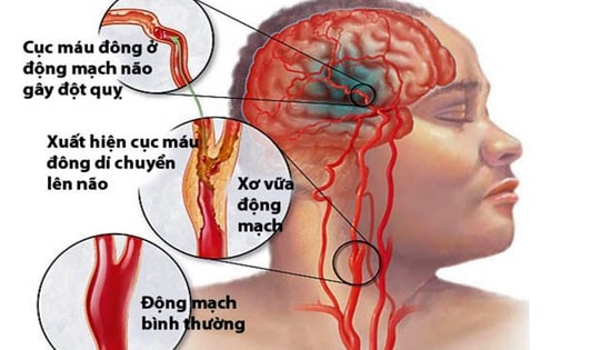 8 nhóm người có nguy cơ đột quỵ cao, đặc biệt nam giới có 2 thói quen này cần cảnh giác