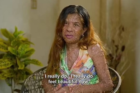 Bệnh lạ khiến bà mẹ hai con có hàng nghìn khối u trên cơ thể