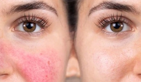 5 dấu hiệu trên khuôn mặt cảnh báo bạn đang bị cao huyết áp