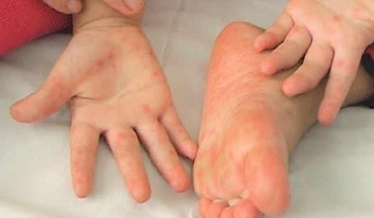 Phát hiện thêm ổ dịch mới, số ca mắc tay chân miệng ở Hà Nội tăng cao