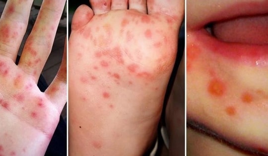 Hà Nội tăng cao các ca tay chân miệng, những trẻ nào là đối tượng nguy cơ dễ mắc bệnh, cần đặc biệt lưu ý?