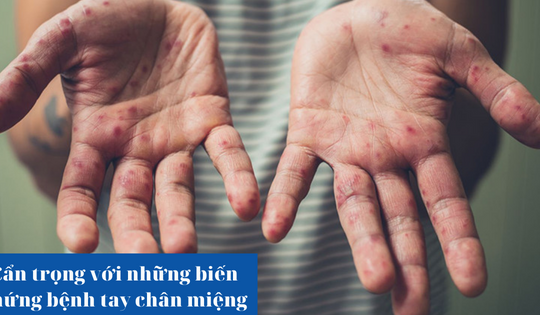 Cẩn trọng với những biến chứng tay chân miệng ở trẻ em!