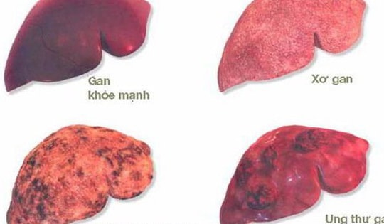 Các dấu hiệu cảnh báo ung thư gan
