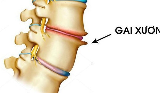 Bài thuốc điều trị gai đốt sống cổ