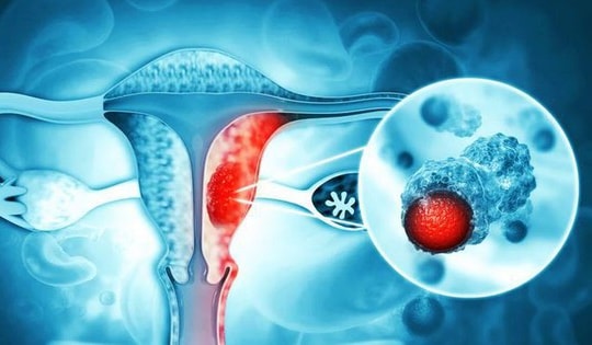 4 loại ung thư thường gặp ở phụ nữ và cách phát hiện sớm