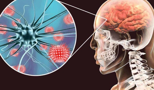 Đau đầu âm ỉ, người đàn ông 42 tuổi bất ngờ phát hiện viêm màng não vì ăn thịt lợn theo cách này