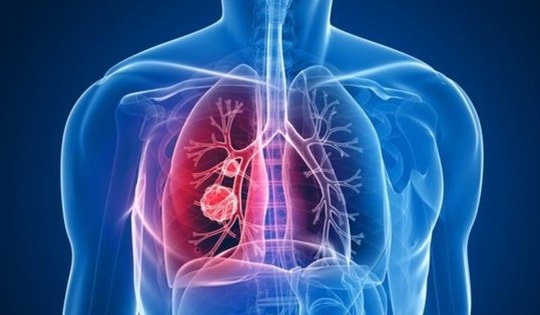 Đau xương khớp kéo dài, cảnh giác với ung thư phổi di căn