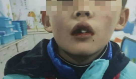 Nam sinh ngã rụng 5 chiếc răng, cốc sữa tươi của giáo viên trở thành "vật cứu mạng"