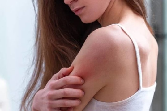 5 dấu hiệu trên da cảnh báo dị ứng với rượu, bia