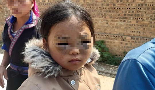 Thông tin mới vụ học sinh lớp 1 nghi bị cô giáo đánh tím mắt ở Yên Bái