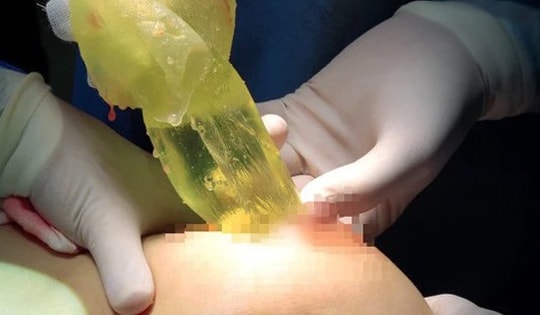 2 phụ nữ bị vỡ túi ngực mà không biết, chuyên gia cảnh báo biến chứng khó lường, chị em nâng ngực có dấu hiệu này cần khám ngay