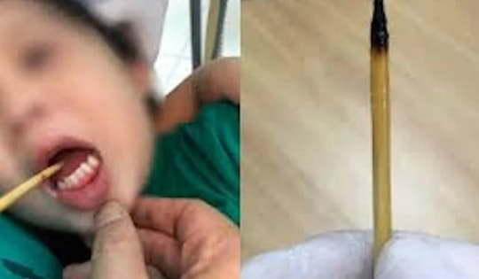 Bé 3 tuổi bị que xiên thịt đâm xuyên lưỡi