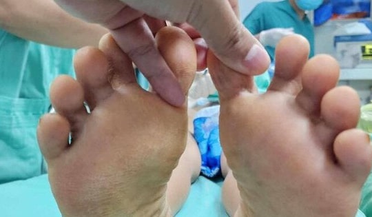 Suýt liệt vĩnh viễn do sử dụng phương pháp dân gian trị đau cột sống