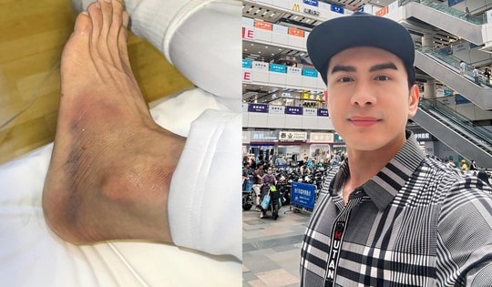 Nam ca sĩ Việt gặp vận xui ở trời Tây: Bị ngã trẹo chân, thất lạc vali nên gần 1 tuần không dám gội đầu