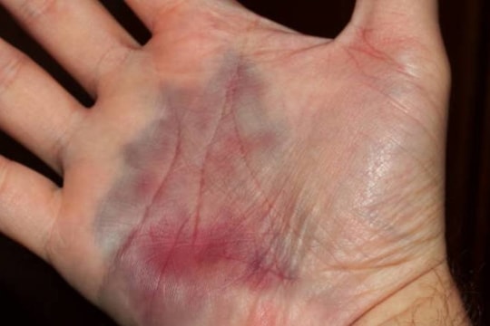 Vết bầm ở bàn tay cảnh báo ung thư máu