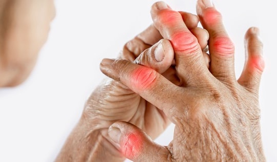 Vì sao cần bổ sung vitamin D khi bị viêm khớp dạng thấp?