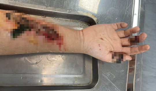 Tự đắp lá vào vết thương, nam bệnh nhân 17 tuổi suýt bị hoại tử cánh tay