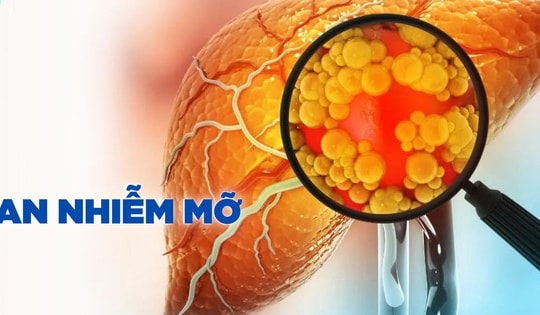 4 cấp độ của bệnh gan nhiễm mỡ, ai không có xin chúc mừng