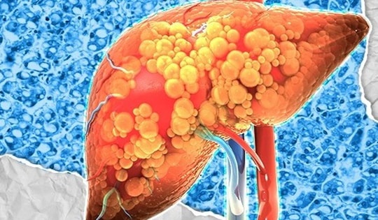 9 món ăn bài thuốc hỗ trợ điều trị bệnh gan nhiễm mỡ hiệu quả nhất