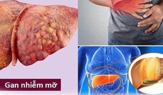 6 nhóm người có nguy cơ cao mắc bệnh gan nhiễm mỡ